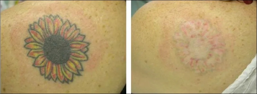 tattoo-removal-1.jpg