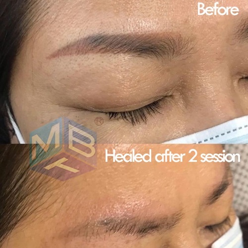 before after eyebrow removal2.jpg
