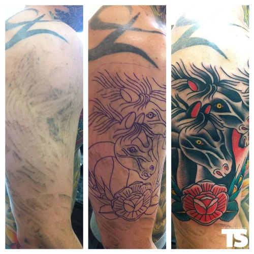 tattoo-removal-treatment-500x500.jpg