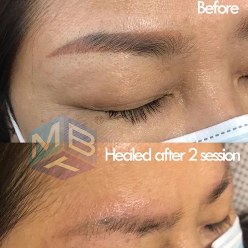 before after eyebrow removal2.jpg