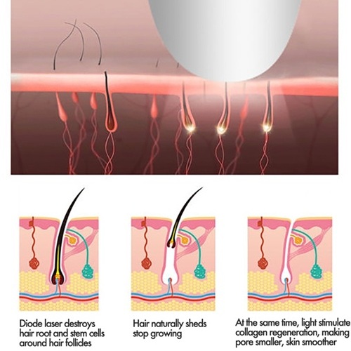 Technology-Hair-Removal-Laser-Machine-Ic