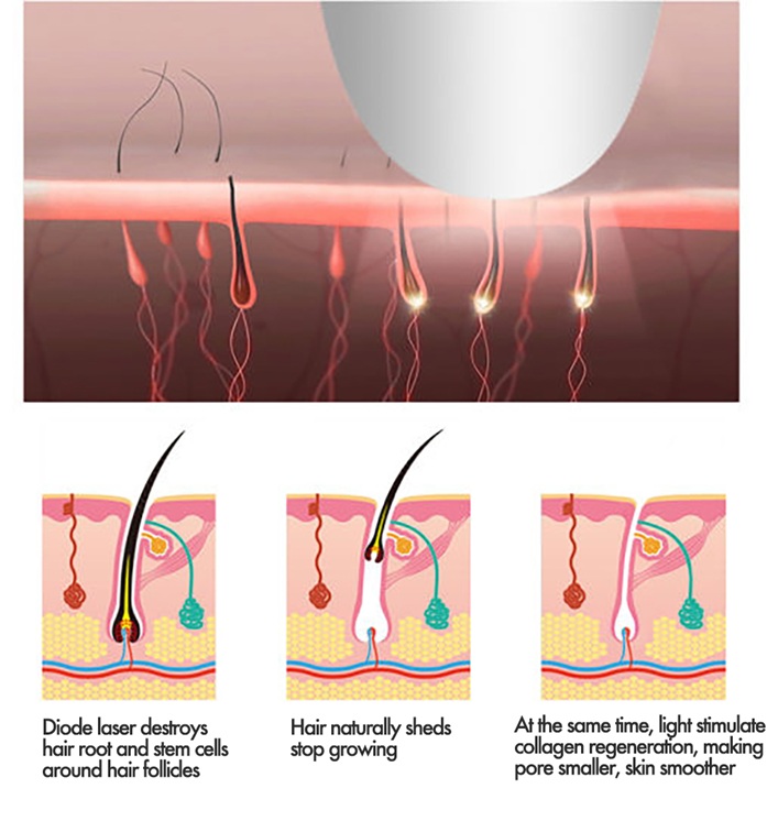 03 Technology-Hair-Removal-Laser-Machine