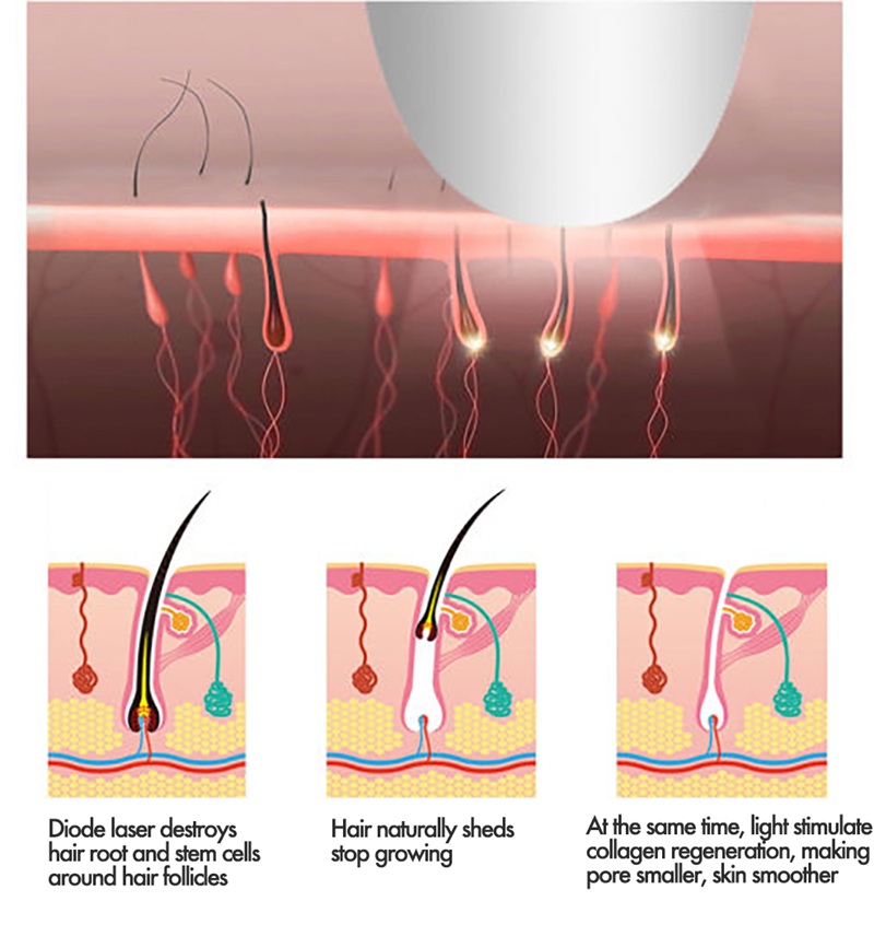 Technology-Hair-Removal-Laser-Machine-Ic