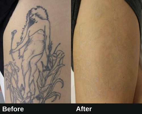 Laser_tattoo_removal_before_and_after_Lo