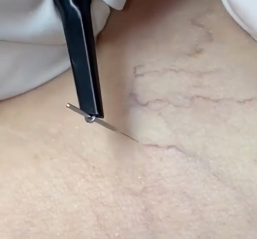 02 RBS spider vein removal1.jpg