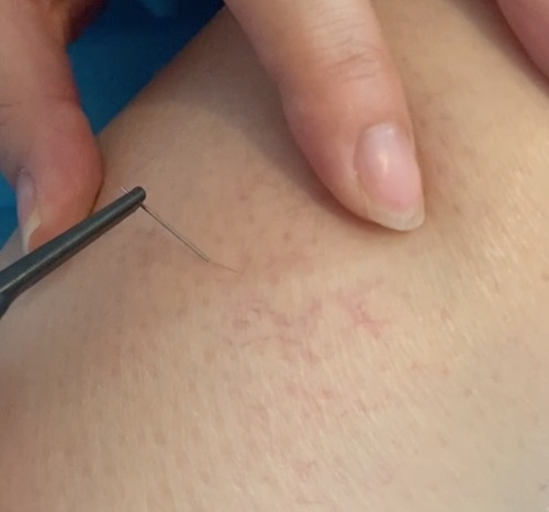 02 RBS spider vein removal2.jpg