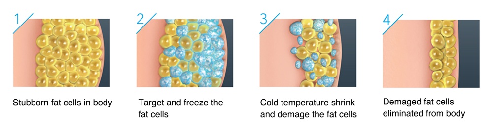 cryolipolysis working principle.jpg